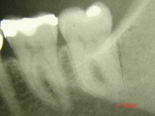 Zahnarzt München : minimalinvasives Entfernen einer krummen Zahnwurzel