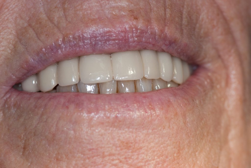 Zahnimplantat Ästhetik Brücke statt Prothese