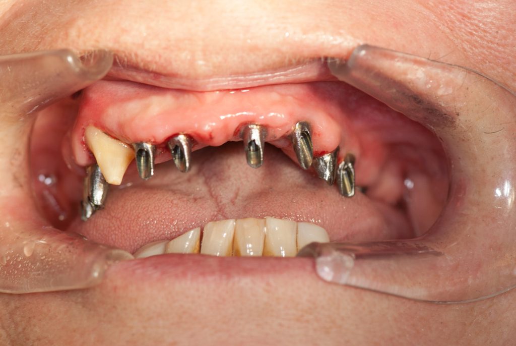 Gefühl für Biss bei Zahnimplantate durch Wurzelhaut von nur 1 Zahn möglich