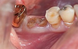 Zahnimplantate sofort nach der Extraktion gegen Knochenverlust statt teurer Knochenaufbau