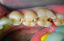 Zahnarzt München: schöne ästhetische Kunststoffüllungen retten die kariösen Zähne