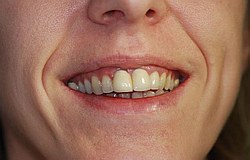 Zahnarzt München: Sanierung des Zahngebisses Totalsanierung