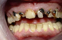 Zahnarzt München: Zähne wieder wie neu mit Zahnimplantat und Zirkonkronen
