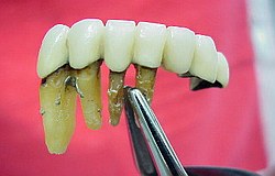 Zahnarzt München: Zahnfleischschmerzen oder Zahnschmerzen