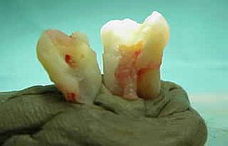 Zahnarzt München: wie entsteht der Zahnschmerz - Zahnnerv