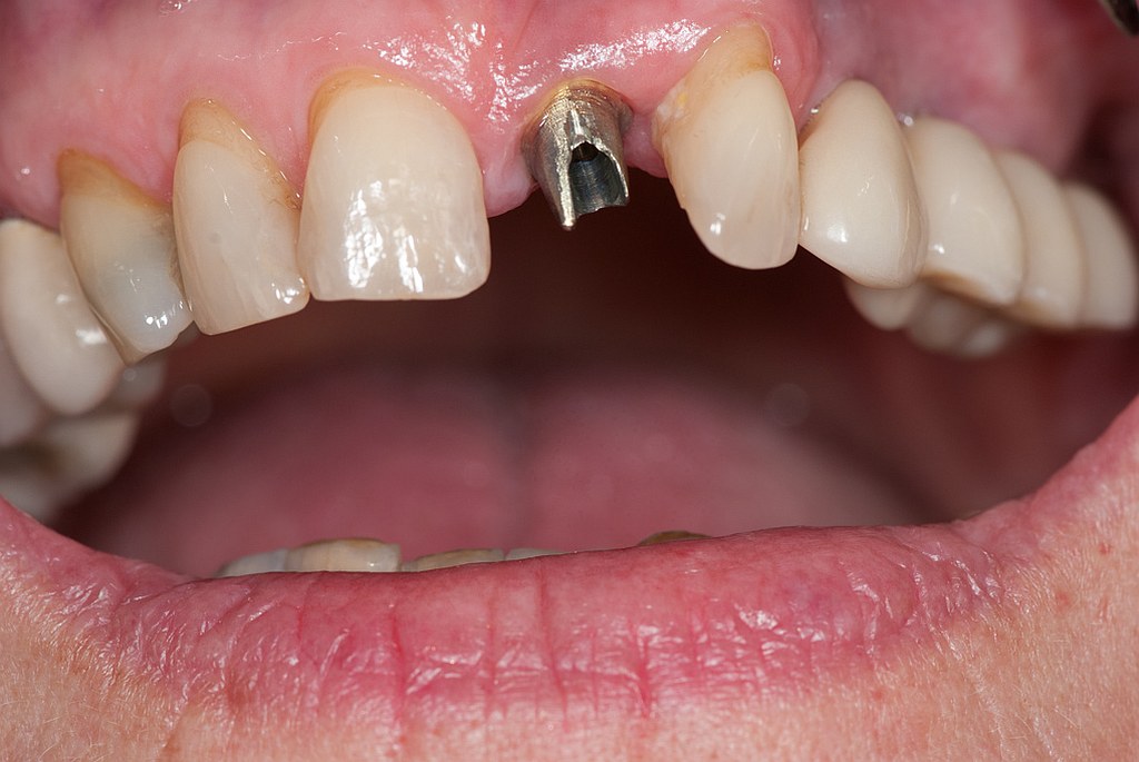 Zahnimplantat Abheilung und Belastbarkeit schon nach 8 Wochen