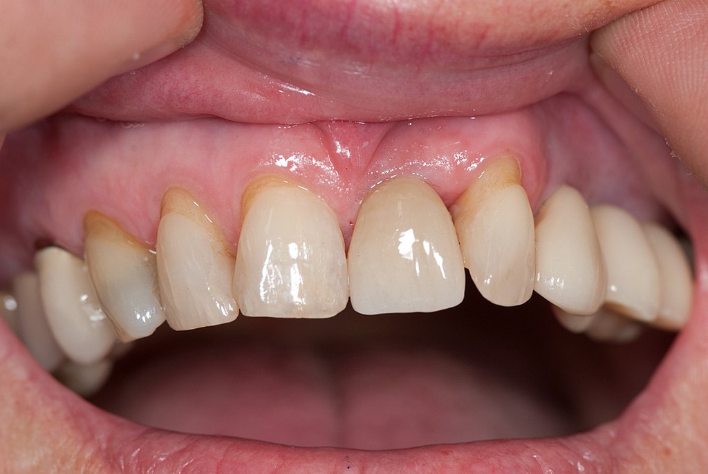 natürlicher Übergang Zahnfleisch Zahnimplantat Zahnkrone